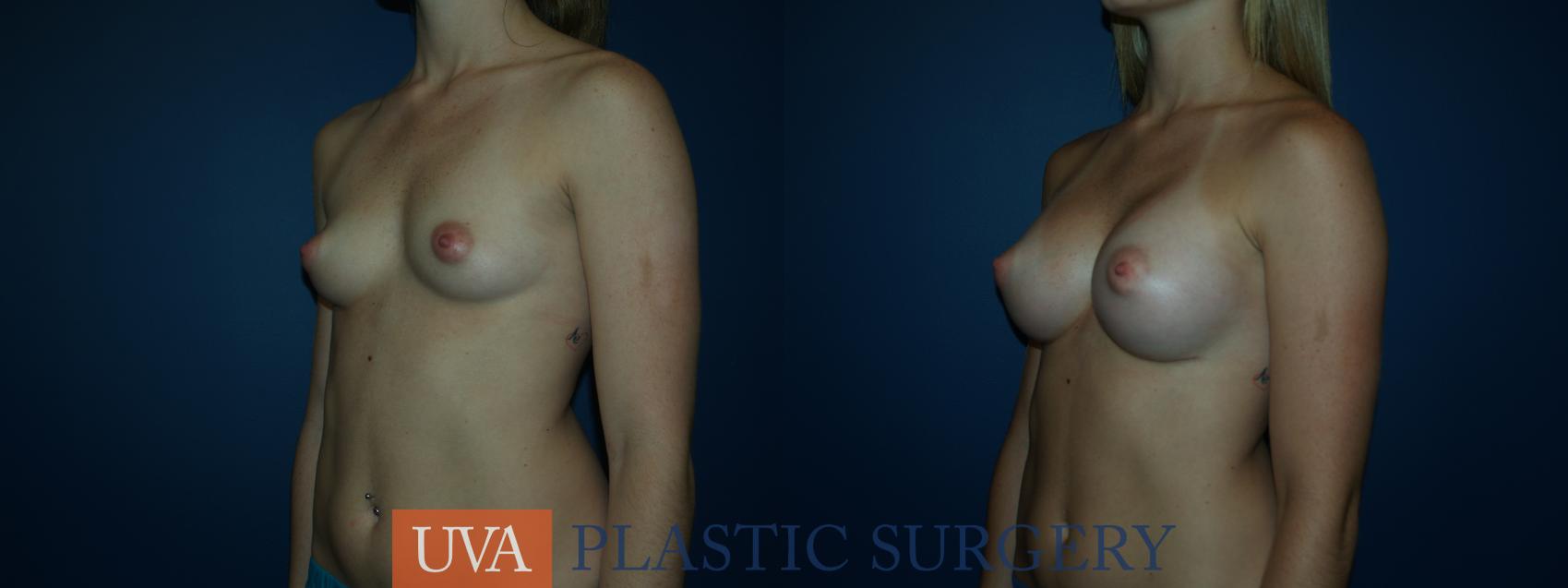 Breast Augmentation Case 37 Before & After View #4 | Charlottesville & Fishersville, VA | University of Virginia Plastic Surgery