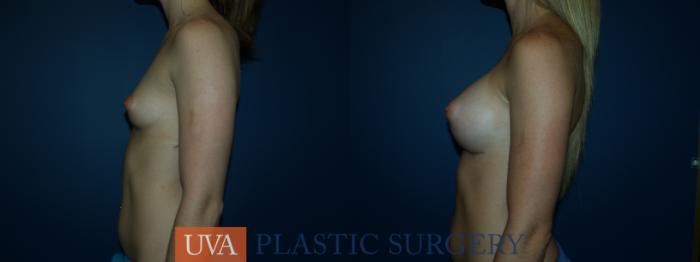 Breast Augmentation Case 37 Before & After View #5 | Charlottesville & Fishersville, VA | University of Virginia Plastic Surgery