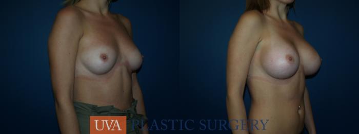 Breast Augmentation Case 39 Before & After View #2 | Richmond, Charlottesville & Roanoke, VA | University of Virginia Plastic Surgery