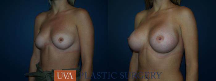 Breast Augmentation Case 39 Before & After View #3 | Richmond, Charlottesville & Roanoke, VA | University of Virginia Plastic Surgery