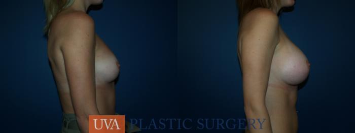 Breast Augmentation Case 39 Before & After View #4 | Richmond, Charlottesville & Roanoke, VA | University of Virginia Plastic Surgery