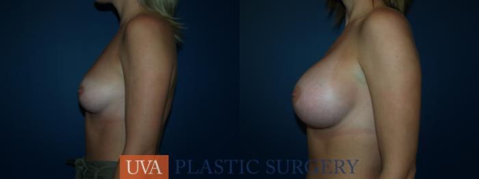 Breast Augmentation Case 39 Before & After View #5 | Richmond, Charlottesville & Roanoke, VA | University of Virginia Plastic Surgery