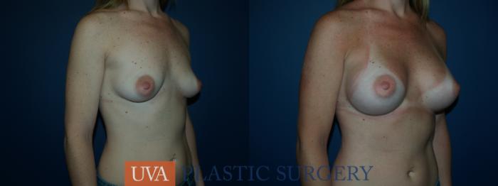 Breast Augmentation Case 40 Before & After View #2 | Richmond, Charlottesville & Roanoke, VA | University of Virginia Plastic Surgery