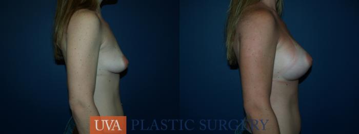 Breast Augmentation Case 40 Before & After View #3 | Richmond, Charlottesville & Roanoke, VA | University of Virginia Plastic Surgery