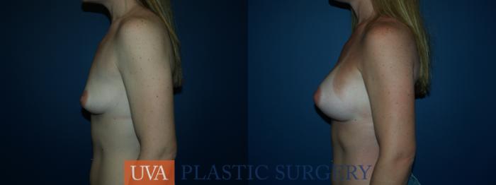 Breast Augmentation Case 40 Before & After View #5 | Richmond, Charlottesville & Roanoke, VA | University of Virginia Plastic Surgery