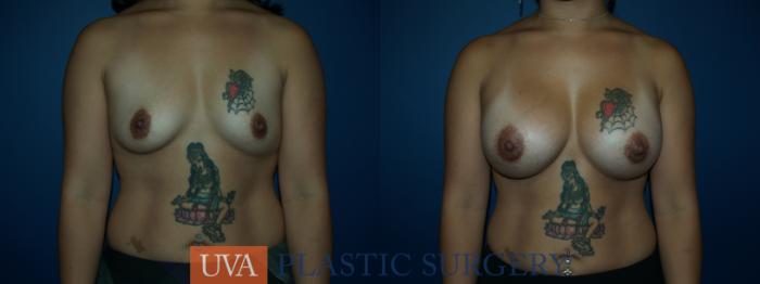Breast Augmentation Case 41 Before & After View #1 | Richmond, Charlottesville & Roanoke, VA | University of Virginia Plastic Surgery