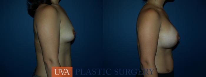 Breast Augmentation Case 41 Before & After View #4 | Richmond, Charlottesville & Roanoke, VA | University of Virginia Plastic Surgery