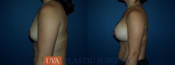 Breast Augmentation Case 41 Before & After View #5 | Richmond, Charlottesville & Roanoke, VA | University of Virginia Plastic Surgery