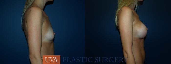 Breast Augmentation Case 44 Before & After View #3 | Richmond, Charlottesville & Roanoke, VA | University of Virginia Plastic Surgery