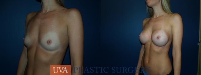 Breast Augmentation Case 44 Before & After View #4 | Richmond, Charlottesville & Roanoke, VA | University of Virginia Plastic Surgery
