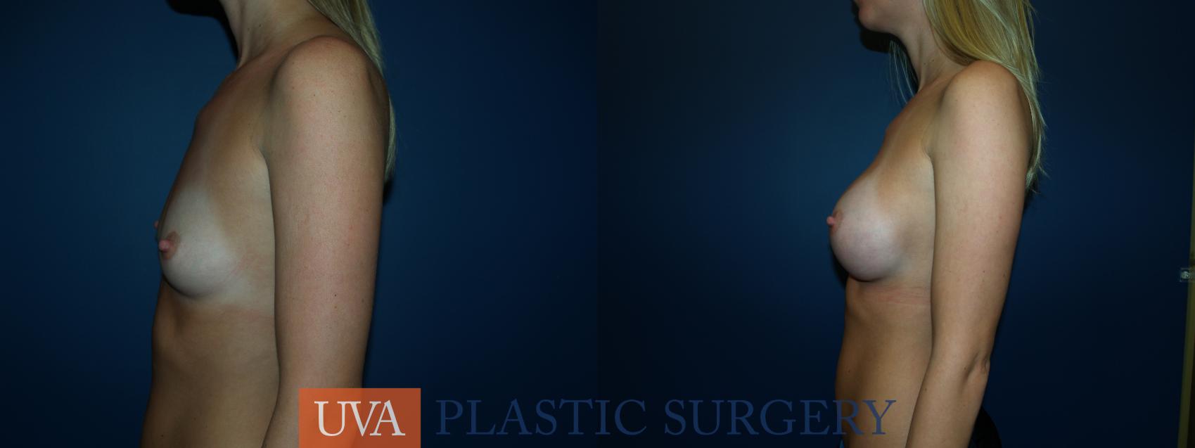 Breast Augmentation Case 44 Before & After View #5 | Charlottesville & Fishersville, VA | University of Virginia Plastic Surgery