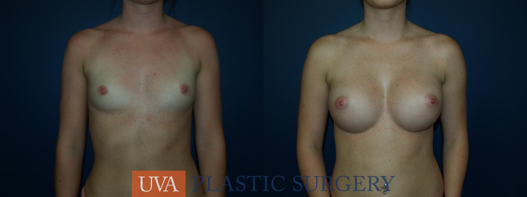 Breast Augmentation Case 45 Before & After View #1 | Richmond, Charlottesville & Roanoke, VA | University of Virginia Plastic Surgery