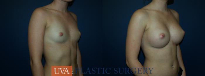 Breast Augmentation Case 45 Before & After View #2 | Richmond, Charlottesville & Roanoke, VA | University of Virginia Plastic Surgery