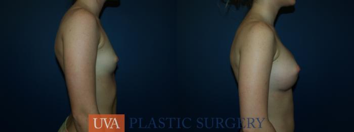 Breast Augmentation Case 45 Before & After View #3 | Richmond, Charlottesville & Roanoke, VA | University of Virginia Plastic Surgery
