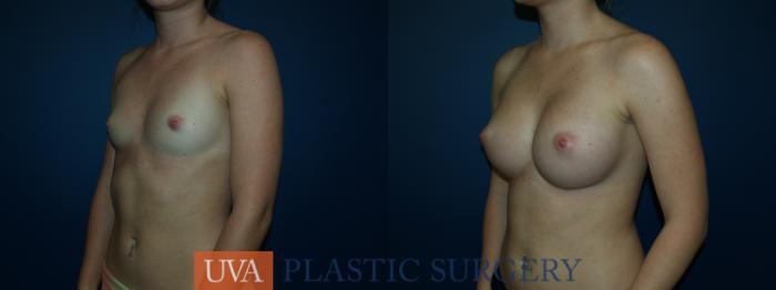 Breast Augmentation Case 45 Before & After View #4 | Richmond, Charlottesville & Roanoke, VA | University of Virginia Plastic Surgery
