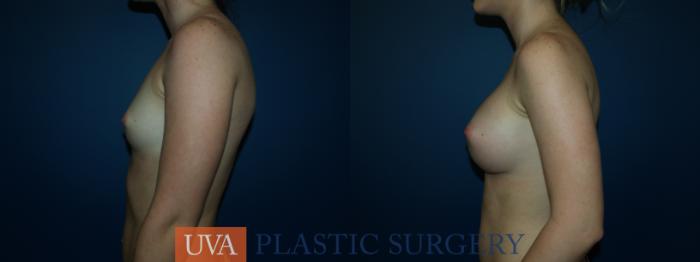 Breast Augmentation Case 45 Before & After View #5 | Richmond, Charlottesville & Roanoke, VA | University of Virginia Plastic Surgery