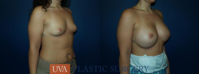 Breast Augmentation Case 47 Before & After View #2 | Richmond, Charlottesville & Roanoke, VA | University of Virginia Plastic Surgery