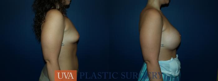 Breast Augmentation Case 47 Before & After View #3 | Richmond, Charlottesville & Roanoke, VA | University of Virginia Plastic Surgery