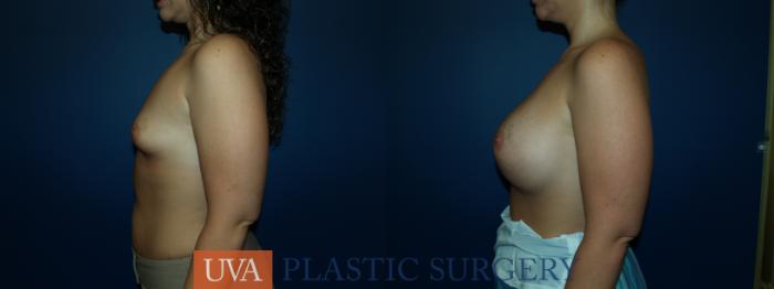 Breast Augmentation Case 47 Before & After View #5 | Richmond, Charlottesville & Roanoke, VA | University of Virginia Plastic Surgery