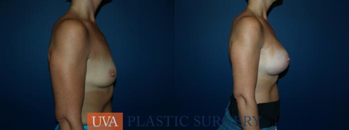 Breast Augmentation Case 48 Before & After View #3 | Richmond, Charlottesville & Roanoke, VA | University of Virginia Plastic Surgery