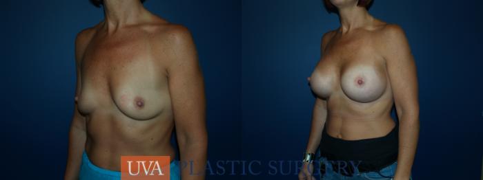 Breast Augmentation Case 48 Before & After View #4 | Richmond, Charlottesville & Roanoke, VA | University of Virginia Plastic Surgery