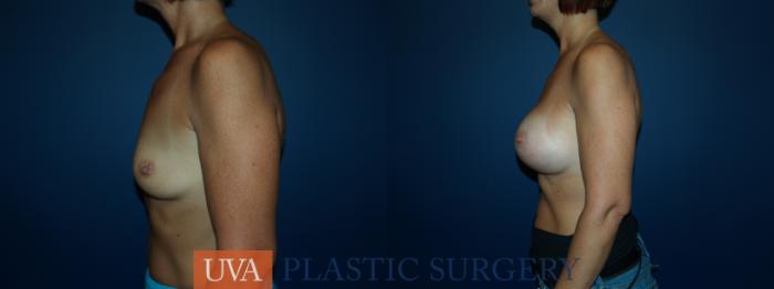 Breast Augmentation Case 48 Before & After View #5 | Richmond, Charlottesville & Roanoke, VA | University of Virginia Plastic Surgery