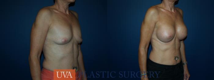Breast Augmentation Case 49 Before & After View #2 | Richmond, Charlottesville & Roanoke, VA | University of Virginia Plastic Surgery