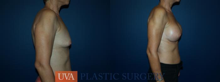 Breast Augmentation Case 49 Before & After View #3 | Richmond, Charlottesville & Roanoke, VA | University of Virginia Plastic Surgery