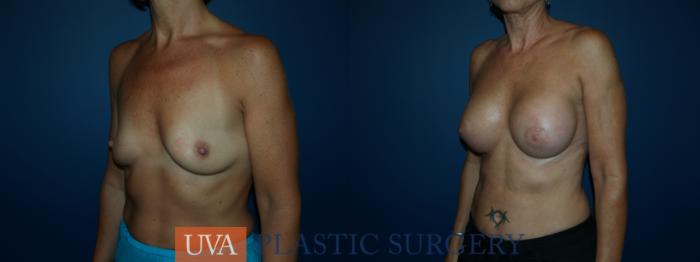 Breast Augmentation Case 49 Before & After View #4 | Richmond, Charlottesville & Roanoke, VA | University of Virginia Plastic Surgery