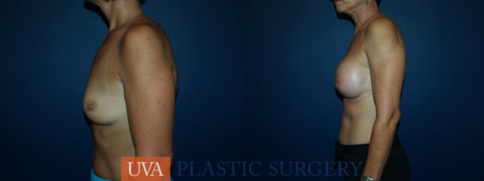 Breast Augmentation Case 49 Before & After View #5 | Richmond, Charlottesville & Roanoke, VA | University of Virginia Plastic Surgery