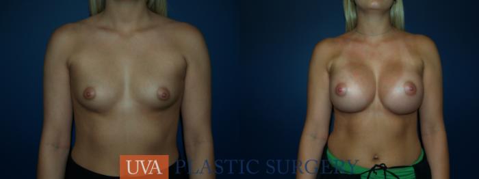 Breast Augmentation Case 50 Before & After View #1 | Richmond, Charlottesville & Roanoke, VA | University of Virginia Plastic Surgery