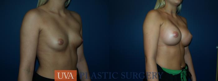 Breast Augmentation Case 50 Before & After View #2 | Richmond, Charlottesville & Roanoke, VA | University of Virginia Plastic Surgery