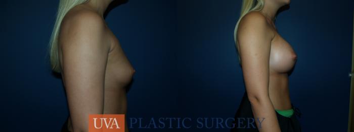 Breast Augmentation Case 50 Before & After View #3 | Richmond, Charlottesville & Roanoke, VA | University of Virginia Plastic Surgery