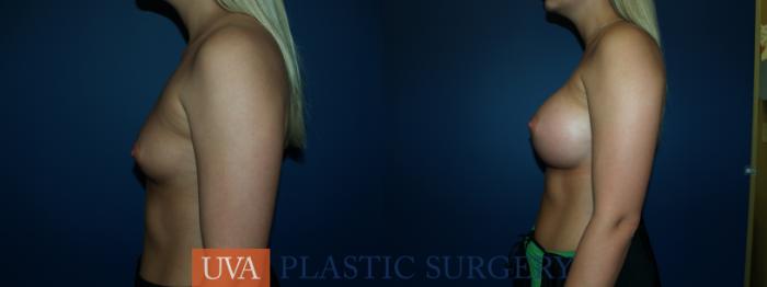 Breast Augmentation Case 50 Before & After View #5 | Richmond, Charlottesville & Roanoke, VA | University of Virginia Plastic Surgery
