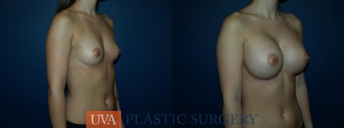 Breast Augmentation Case 51 Before & After View #2 | Charlottesville & Fishersville, VA | University of Virginia Plastic Surgery