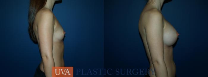 Breast Augmentation Case 51 Before & After View #3 | Charlottesville & Fishersville, VA | University of Virginia Plastic Surgery