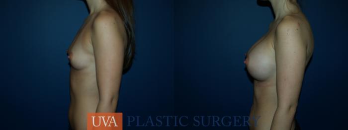 Breast Augmentation Case 51 Before & After View #5 | Charlottesville & Fishersville, VA | University of Virginia Plastic Surgery