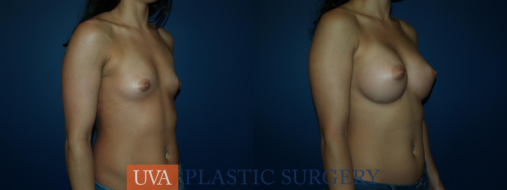 Breast Augmentation Case 52 Before & After View #2 | Charlottesville & Fishersville, VA | University of Virginia Plastic Surgery
