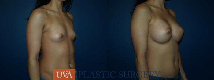 Breast Augmentation Case 52 Before & After View #2 | Richmond, Charlottesville & Roanoke, VA | University of Virginia Plastic Surgery