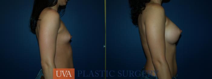 Breast Augmentation Case 52 Before & After View #3 | Richmond, Charlottesville & Roanoke, VA | University of Virginia Plastic Surgery