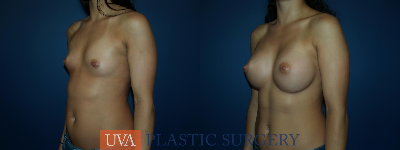 Breast Augmentation Case 52 Before & After View #4 | Charlottesville & Fishersville, VA | University of Virginia Plastic Surgery