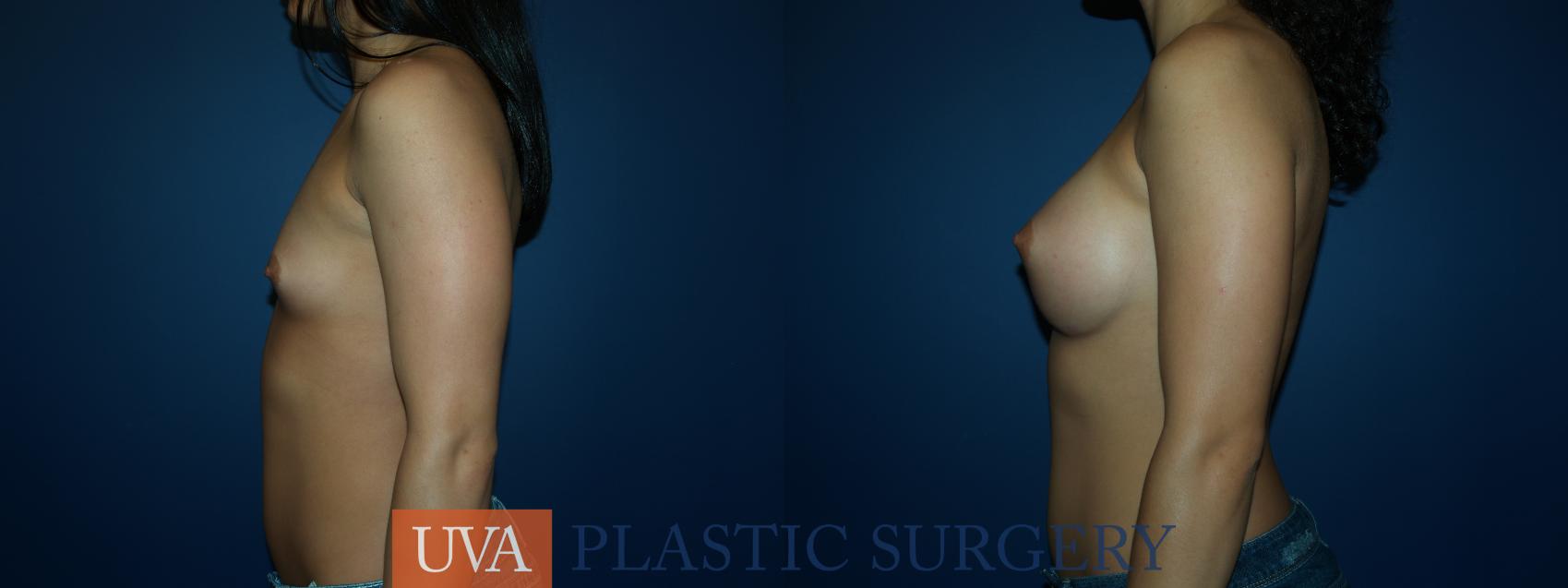 Breast Augmentation Case 52 Before & After View #5 | Charlottesville & Fishersville, VA | University of Virginia Plastic Surgery
