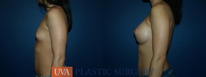Breast Augmentation Case 52 Before & After View #5 | Richmond, Charlottesville & Roanoke, VA | University of Virginia Plastic Surgery