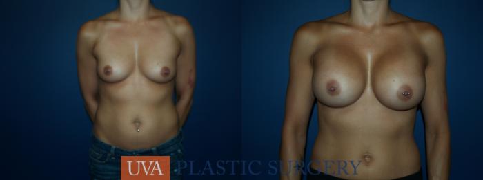 Breast Augmentation Case 54 Before & After View #1 | Richmond, Charlottesville & Roanoke, VA | University of Virginia Plastic Surgery