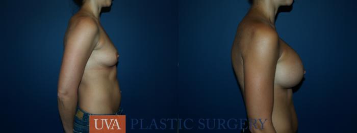 Breast Augmentation Case 54 Before & After View #3 | Richmond, Charlottesville & Roanoke, VA | University of Virginia Plastic Surgery