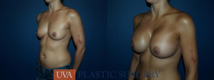 Breast Augmentation Case 54 Before & After View #4 | Richmond, Charlottesville & Roanoke, VA | University of Virginia Plastic Surgery