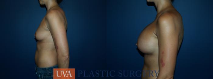 Breast Augmentation Case 54 Before & After View #5 | Richmond, Charlottesville & Roanoke, VA | University of Virginia Plastic Surgery