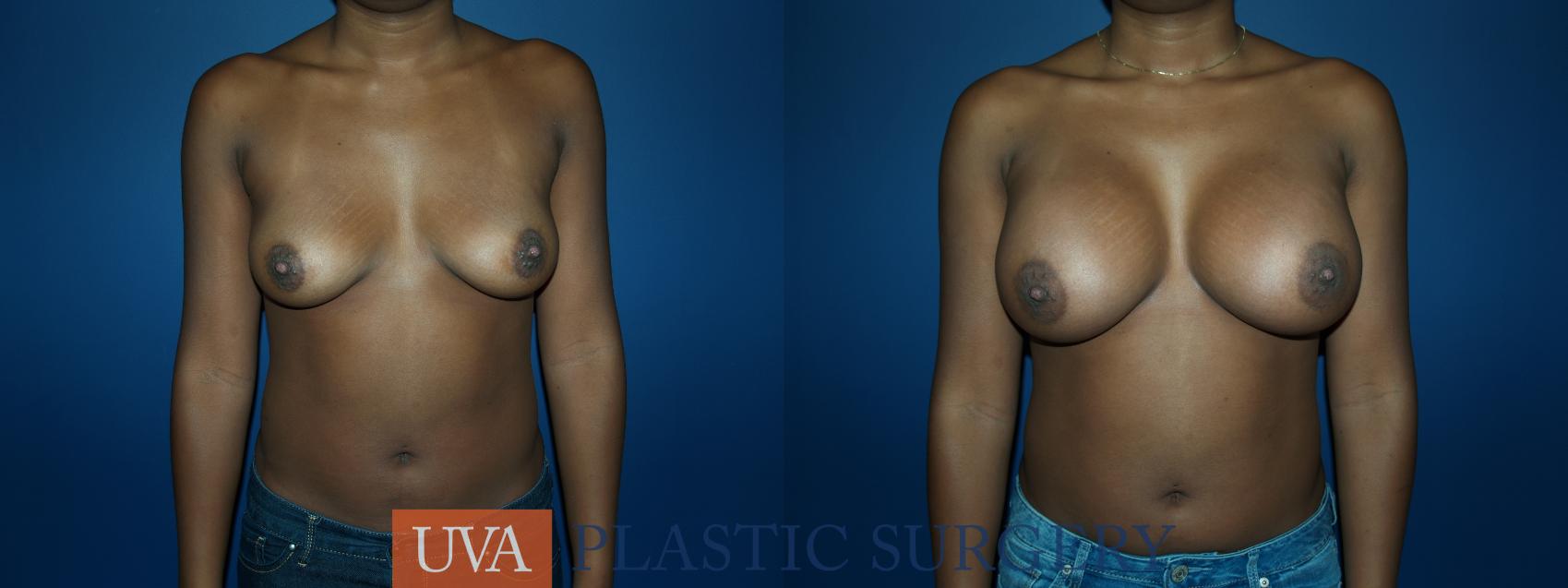 Breast Augmentation Case 55 Before & After View #1 | Charlottesville & Fishersville, VA | University of Virginia Plastic Surgery