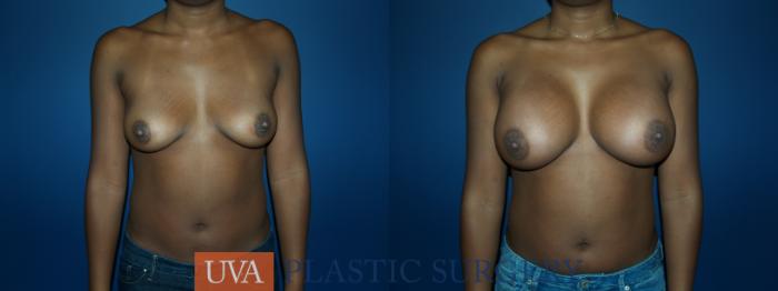 Breast Augmentation Case 55 Before & After View #1 | Richmond, Charlottesville & Roanoke, VA | University of Virginia Plastic Surgery