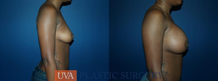 Breast Augmentation Case 55 Before & After View #3 | Richmond, Charlottesville & Roanoke, VA | University of Virginia Plastic Surgery